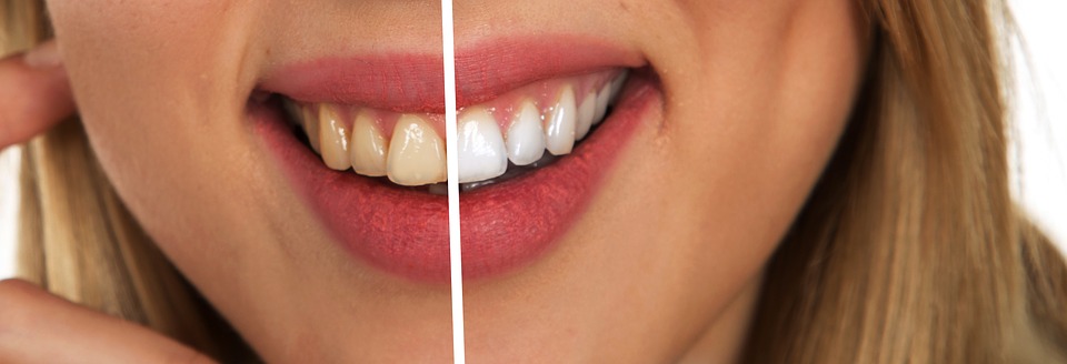 teeth-whitening